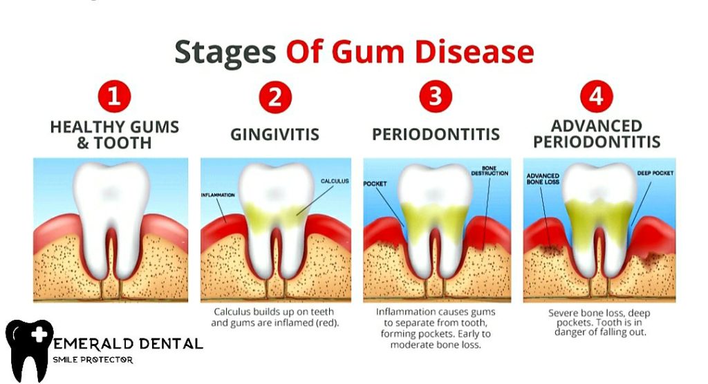 STAGES OF GUM DISEASE - EMERALD DENTAL