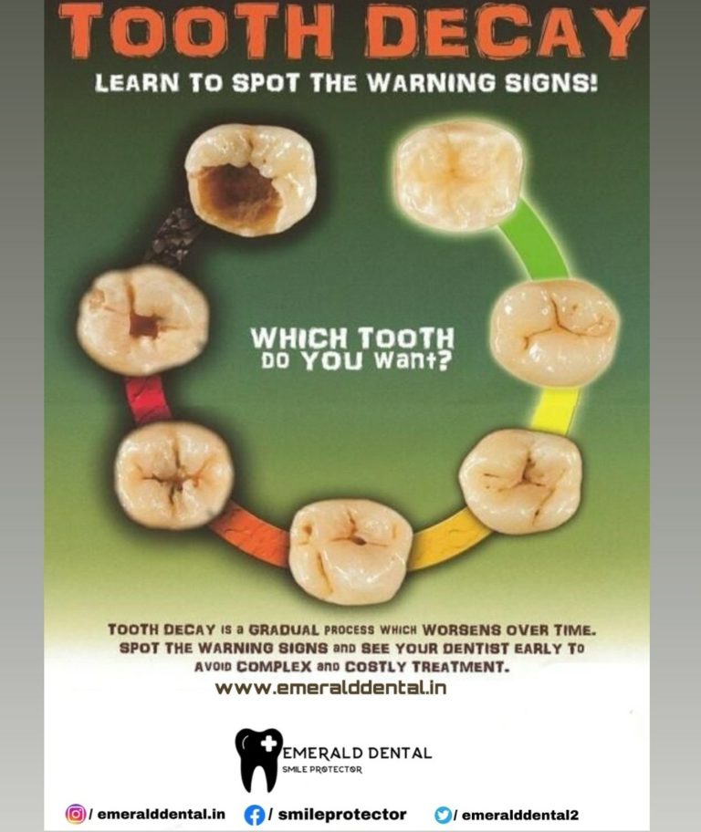 Tooth Decay Learn To Spot The Warning Signs Emerald Dental