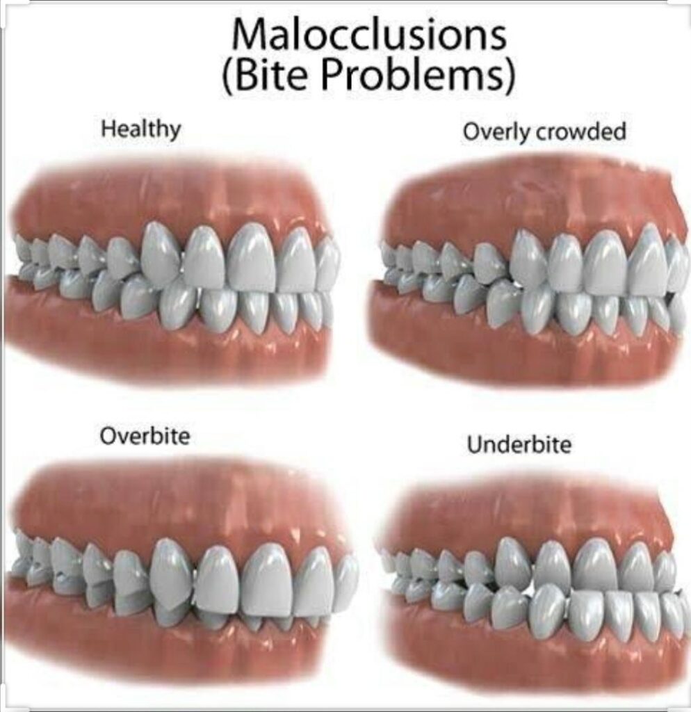 Perfect Bite Teeth Alignment 