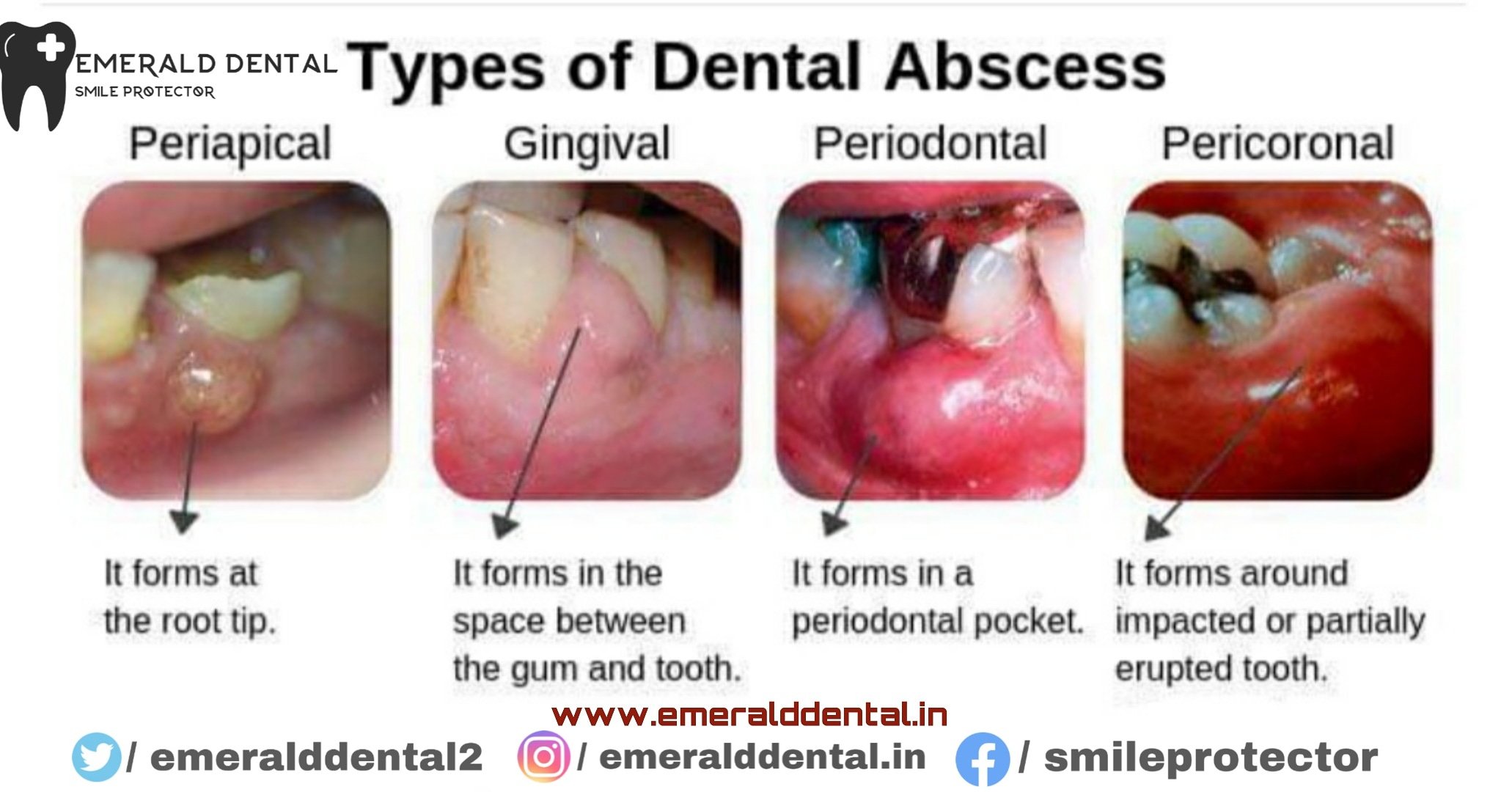 abscess toothpaste