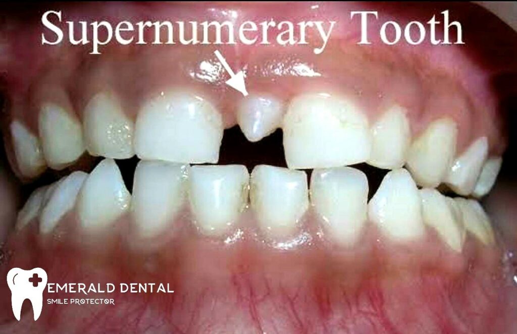 supernumerary-tooth-emerald-dental