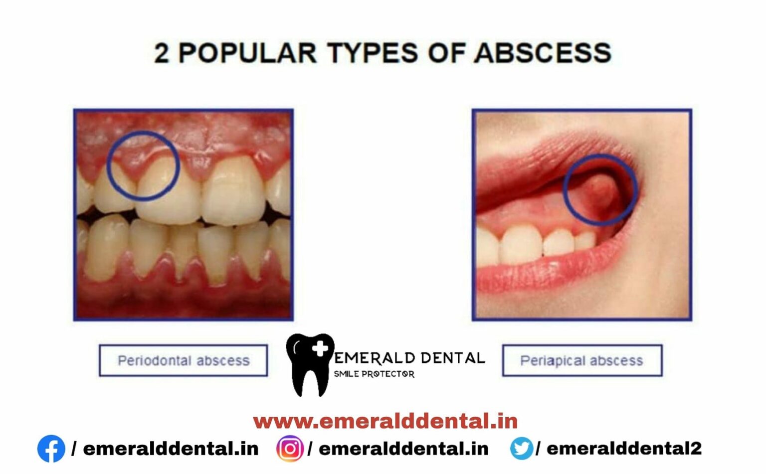 dental-abscess-emerald-dental