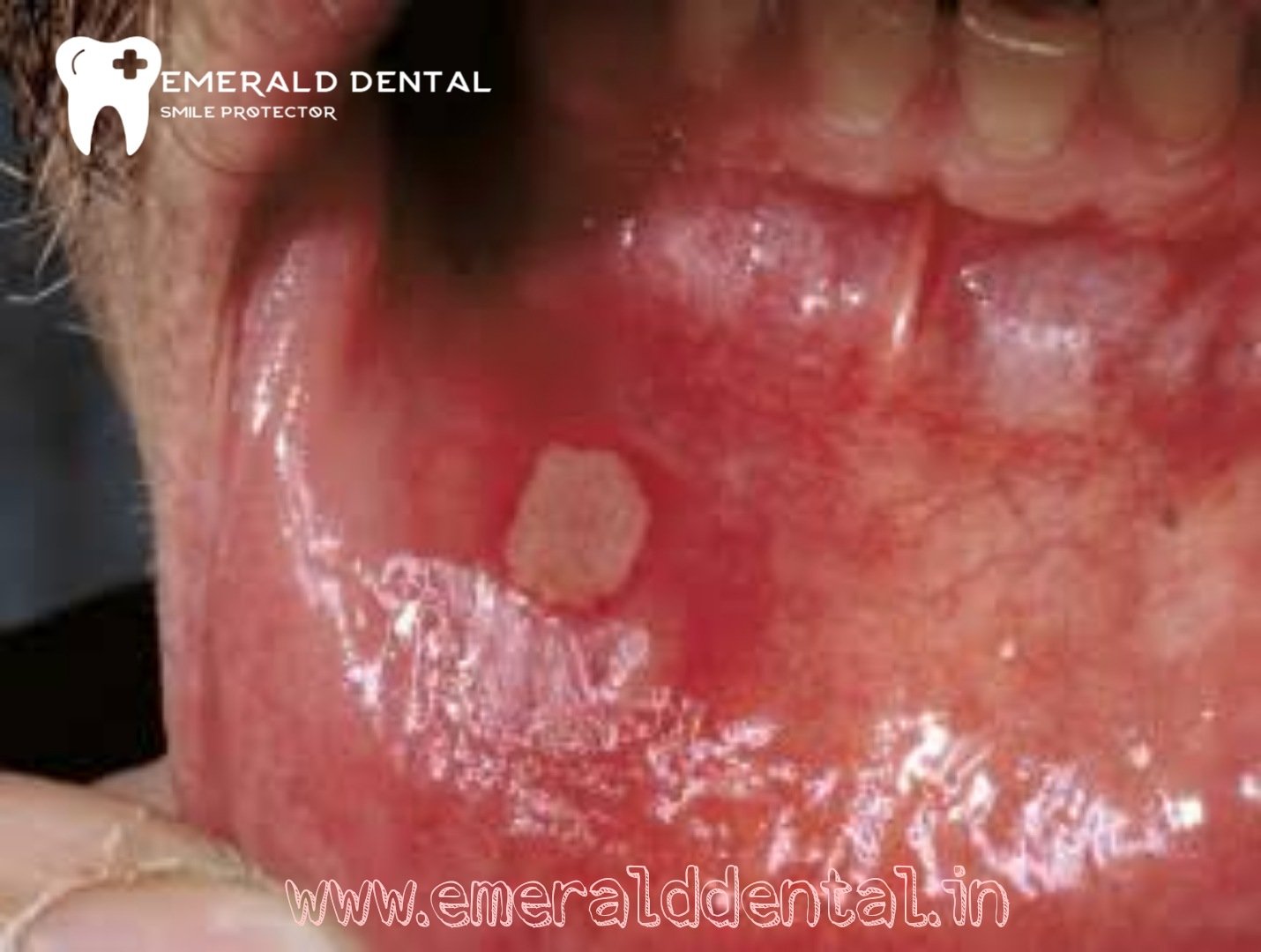 WHAT IS AN APHTHOUS ULCER? - EMERALD DENTAL