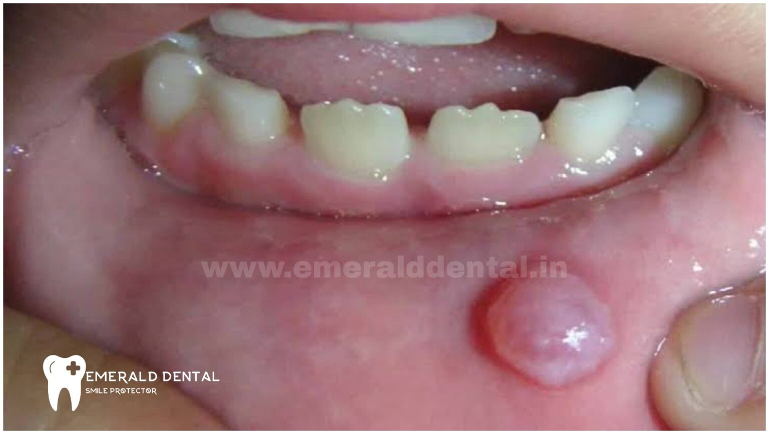 Oral Mucocele Emerald Dental